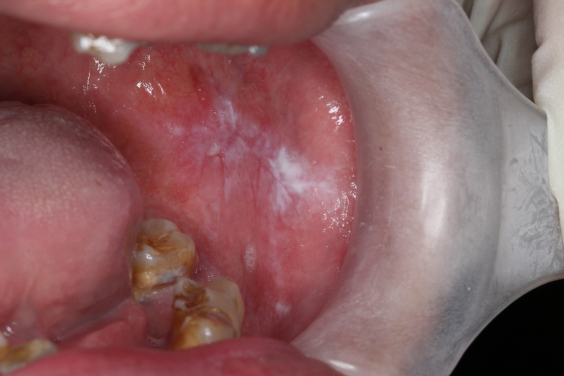Patient suffering from buccal mucosa leukoplakia